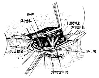 肺切除术图片