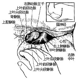 各部位肺切除术图片