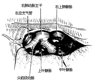 各部位肺切除术图片