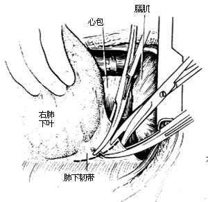 各部位肺切除术图片