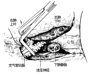 各部位肺切除术图片