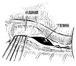 各部位肺切除术图片