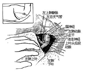 各部位肺切除术图片