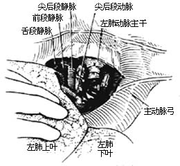 各部位肺切除术图片