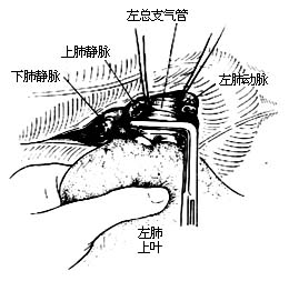 各部位肺切除术图片