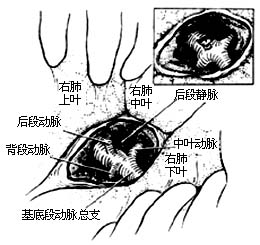 各部位肺切除术图片