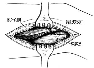 代股四头肌手术图片