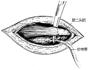 代股四头肌手术图片