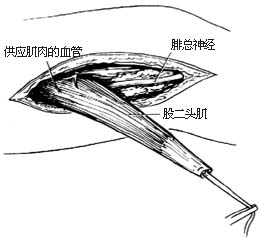 代股四头肌手术图片