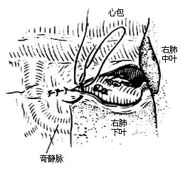 各部位肺切除术图片