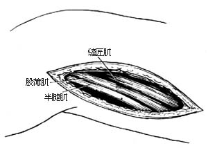 代股四头肌手术图片