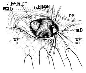 各部位肺切除术图片