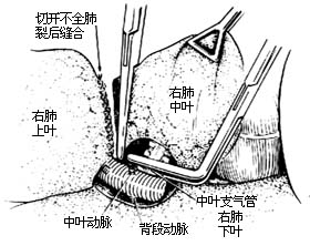 各部位肺切除术图片