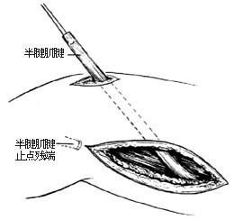 代股四头肌手术图片