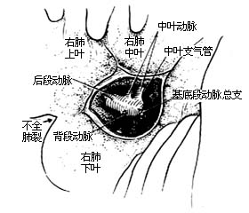 各部位肺切除术图片