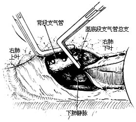 各部位肺切除术图片