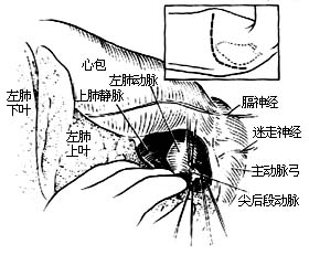 各部位肺切除术图片