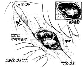 各部位肺切除术图片