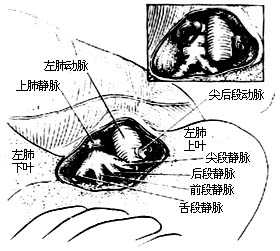 各部位肺切除术图片