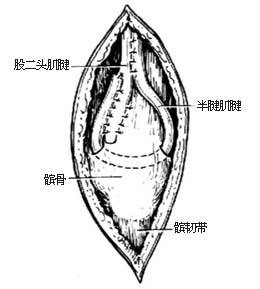 代股四头肌手术图片