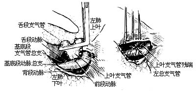 各部位肺切除术图片