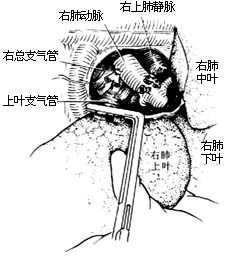 各部位肺切除术图片