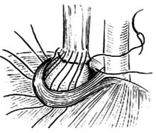 食管裂孔疝修补术图片