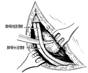 腓骨长肌腱转移术图片