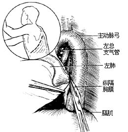 食管癌切除术图片