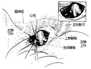 各部位肺切除术图片