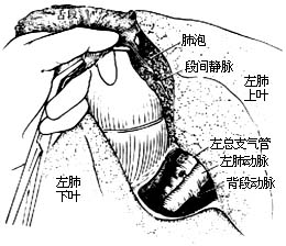 各部位肺切除术图片