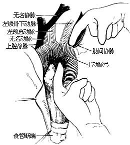 食管癌切除术图片