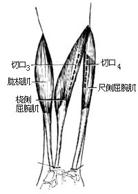 代前臂伸肌手术图片