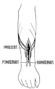 代前臂伸肌手术图片