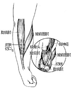 代前臂伸肌手术图片