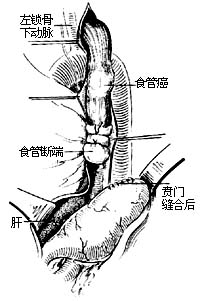 食管癌切除术图片