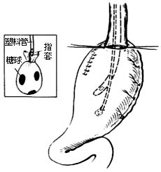 食管癌切除术图片