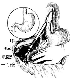 食管癌切除术图片