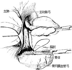 食管癌切除术图片