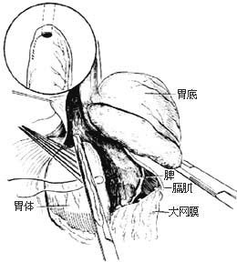 食管癌切除术图片