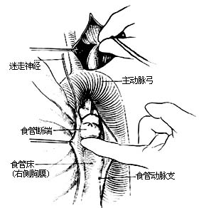 食管癌切除术图片