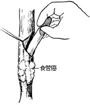 食管癌姑息手术图片