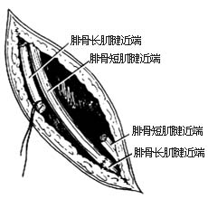 腓骨长肌腱转移术图片