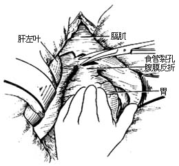 食管贲门肌层切开术图片