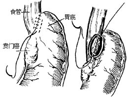 食管癌姑息手术图片