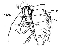 食管贲门肌层切开术图片