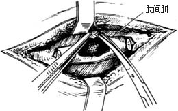 胸壁结核病灶清除术图片