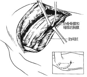 胸膜内胸廓成形术图片