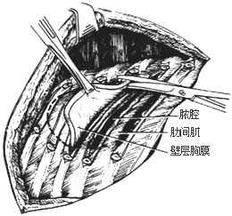 胸膜内胸廓成形术图片