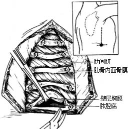 胸膜内胸廓成形术图片